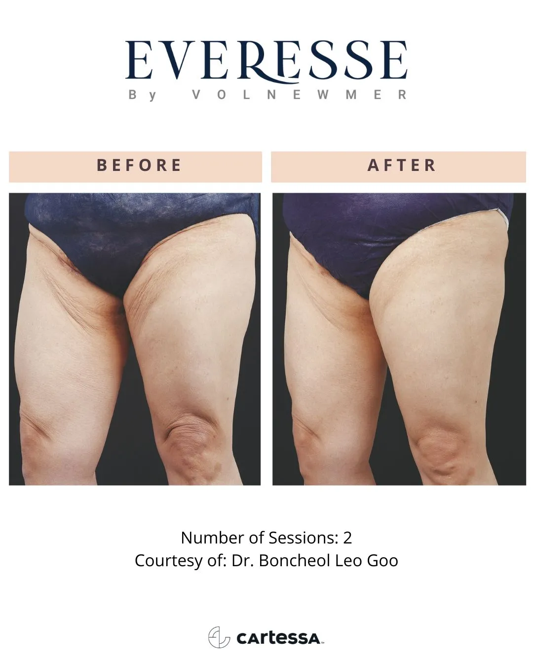 Everesse™ by Cartessa Before and After Result | Bijoux Med Spa in Orlando, FL