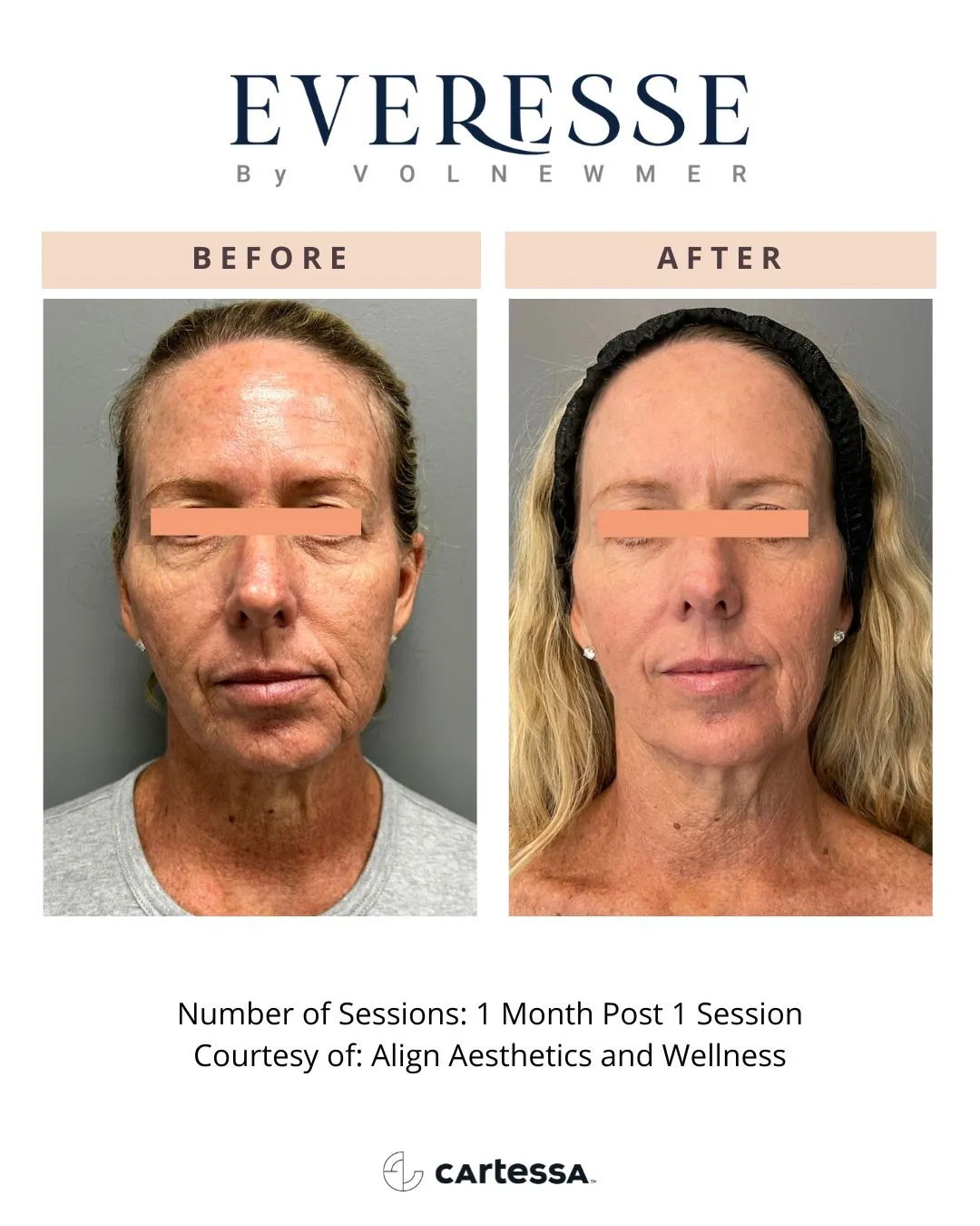 Everesse™ by Cartessa Before and After Result | Bijoux Med Spa in Orlando, FL