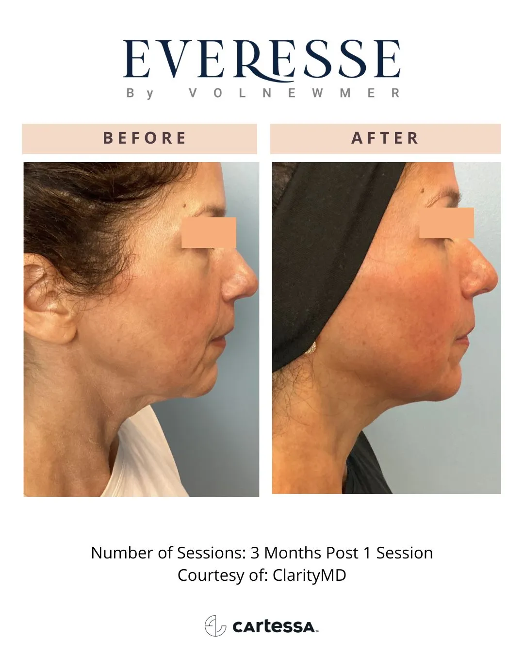 Everesse™ by Cartessa Before and After Result | Bijoux Med Spa in Orlando, FL