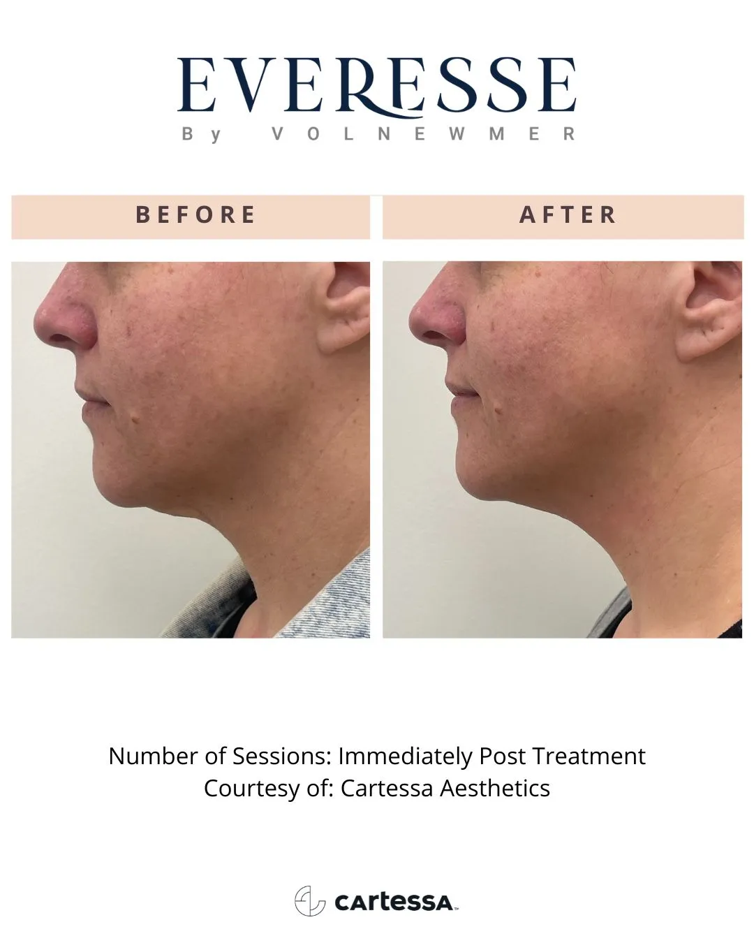 Everesse™ by Cartessa Before and After Result | Bijoux Med Spa in Orlando, FL