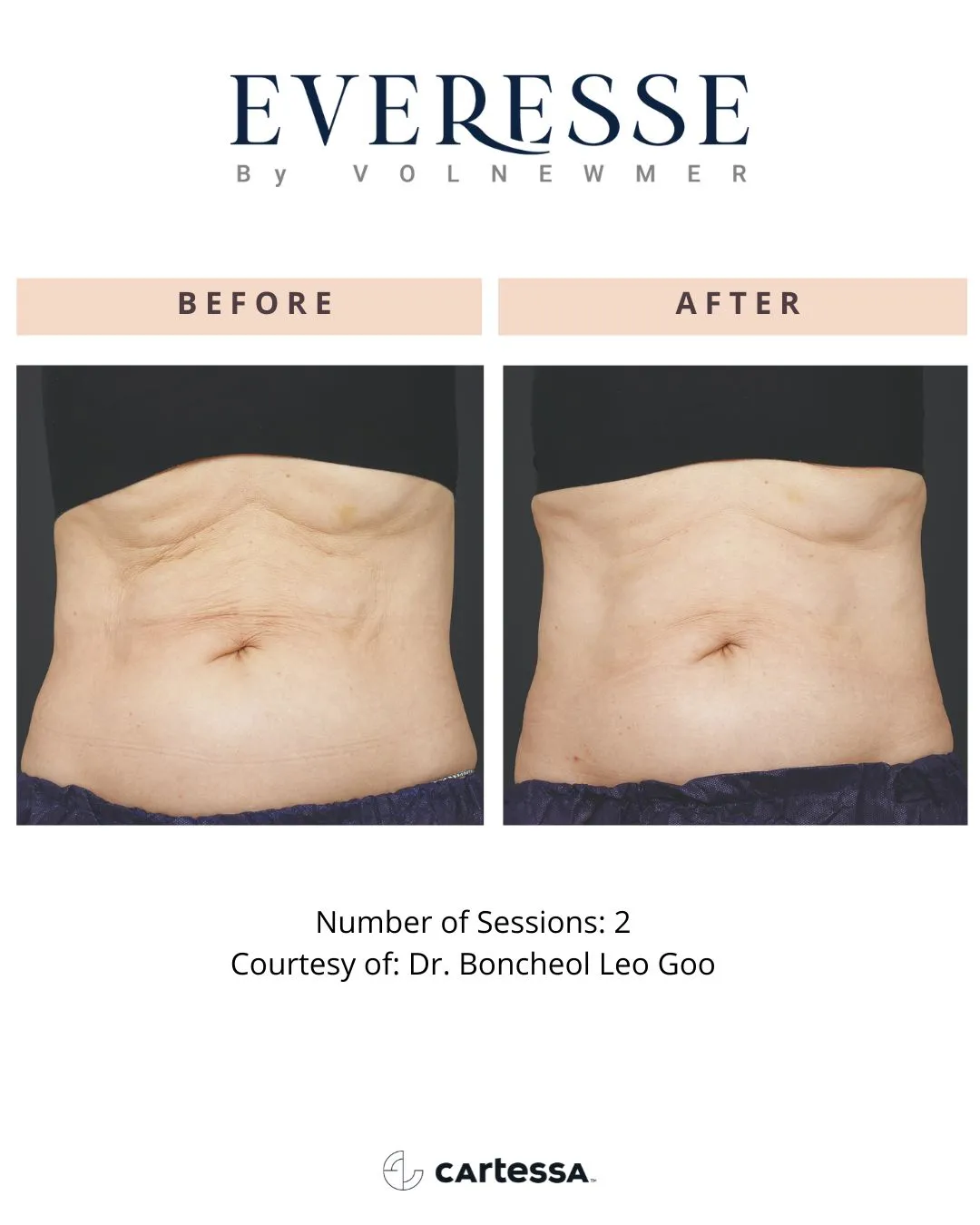 Everesse™ by Cartessa Before and After Result | Bijoux Med Spa in Orlando, FL